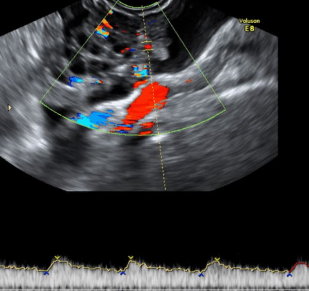 pco color doppler