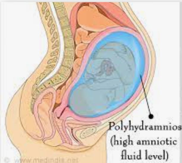 پلی هیدرآمنیوس polyhydramnios
