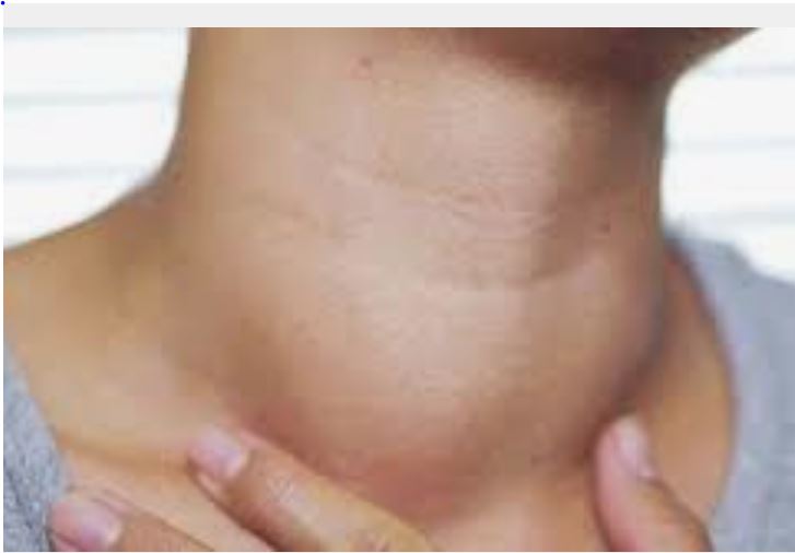 thyroid nodule ندول تیروئید