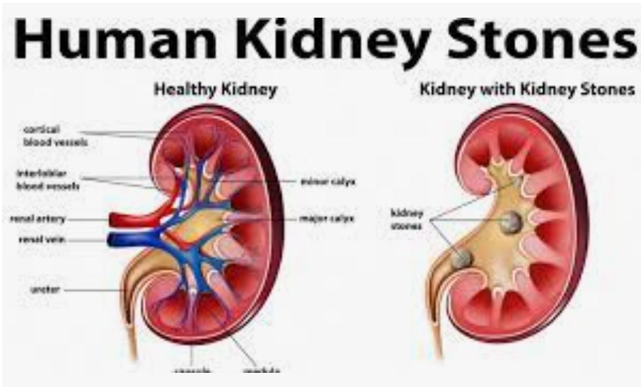 سنگ های کلیه و مجاری ادراری؛renal stone