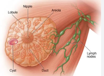 کیست پستان breast cyst _اختلال فیبروکیستی