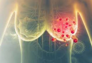 breast cancer_سرطان پستان