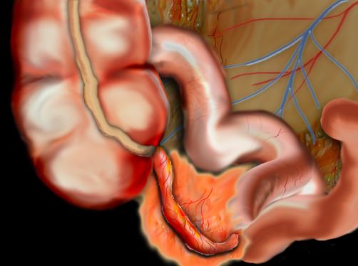 appendicitis-آپاندیسیت - التهاب آپاندیس