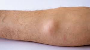 lipoma,لیپوما,madelung syndrom