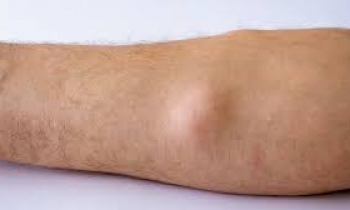 lipoma,لیپوما,madelung syndrom
