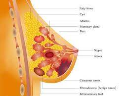 اتساع مجاری پستان یا ductal ectasia