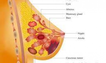 اتساع مجاری پستان یا ductal ectasia