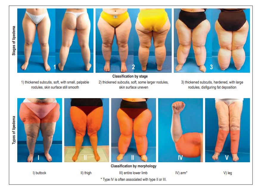 lipedema لیپ ادما